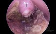 Wtórna infekcja w loży po tonsilektomii