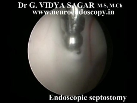 Endoskopowa septostomia