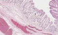 Guz cewkowy (polip gruczolakowaty) - histopatologia - okrężnica