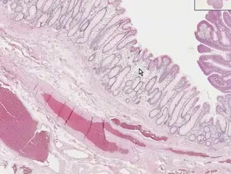 Guz cewkowy (polip gruczolakowaty) - histopatologia - okrężnica