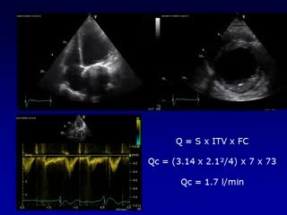 Echokardiograficzny obliczanie pojemności minutowej serca