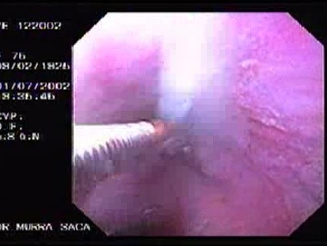 Krwotok - podwiązywanie żylaków przełyku (gumowa opaska) - czwarta skleroterapia