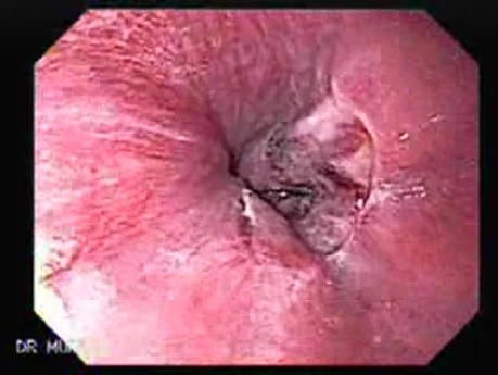 Żylaki żołądka - endoskopowa ablacja klejem cyjanoakrylowym (15 z 18)