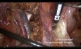 Operacja raka endometrium u pacjentki z otyłością olbrzymią