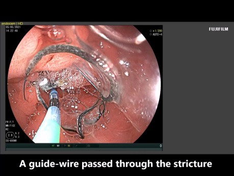 Gastroenterostomia pod kontrolą EUS u pacjenta z wodobrzuszem 