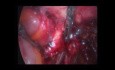 Histerektomia laparoskopowa z powodu endometriozy