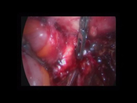 Histerektomia laparoskopowa z powodu endometriozy