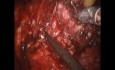 Prostatektomia z użyciem robota