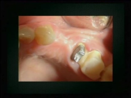 CBCT w analizie i planowaniu zabiegów chirurgiczno-implantologicznych - część 4