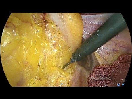 Laparoskopowe całkowite wycięcie mezorektum bez wyłonienia stomii, operacja raka odbytnicy o nazwie Turnbull-Cutait Pull-Through  