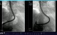 Endoskopowa cystrogastrostomia pozapalnego trzustkowego płynowego