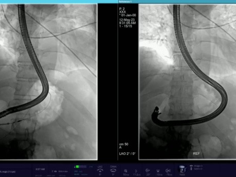 Endoskopowa cystrogastrostomia pozapalnego trzustkowego płynowego