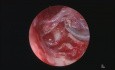 Wyłącznie endoskopowa operacja ucha - perlak