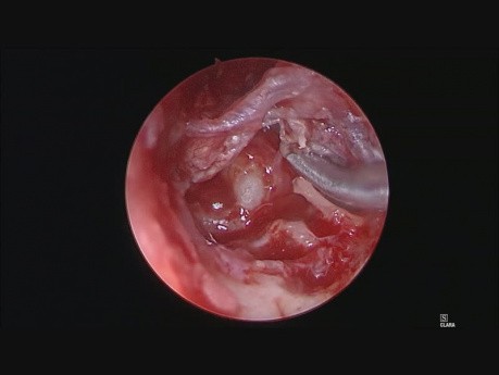 Wyłącznie endoskopowa operacja ucha - perlak