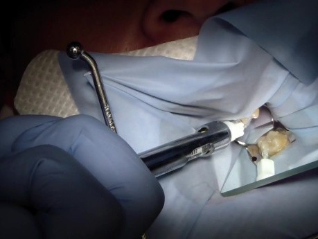 Znieczulenie więzadłowe (PDL) przy użyciu krótkiej igły 30 G (0,3 mm)