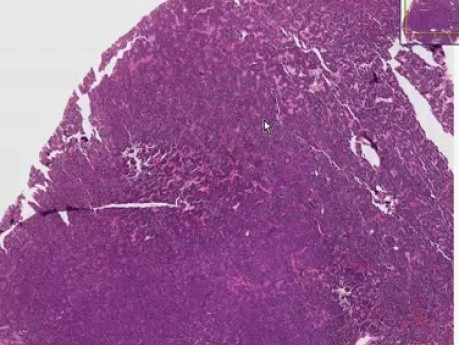 Rak drobnokomórkowy - histopatologia - płuco