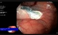 Fragmentaryczna endoskopwa resekcja śluzówki w kątnicy