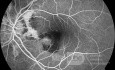 Neowaskularyzacja naczyniówkowa u pacjenta z pasmami naczyniastymi (angiografia fluoresceinowa)