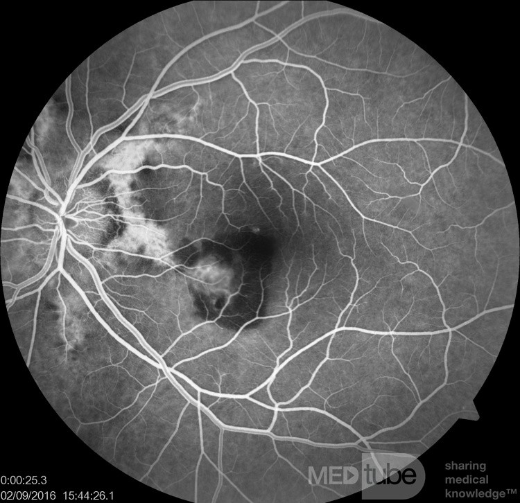 Neowaskularyzacja naczyniówkowa u pacjenta z pasmami naczyniastymi (angiografia fluoresceinowa)