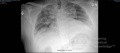 RTG klatki piersiowej - COVID-19 (2)