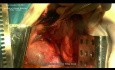 Operacja guza śródpiersia tylnego