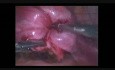Laparoskopowe usunięcie mięśniaka podśluzówkowego wychodzącego przez szyjkę macicy