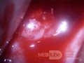 Rak gruczołowy szyjki macicy (Carcinoma Glandulare Colli Uteri)
