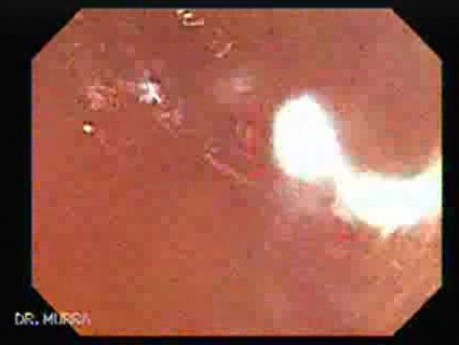 Schistosoma Mansoni w jelicie ślepym (2 z 9)