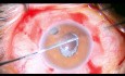 Wtórna implantacja soczewki z dodatkowym mocowaniem siatkówki
