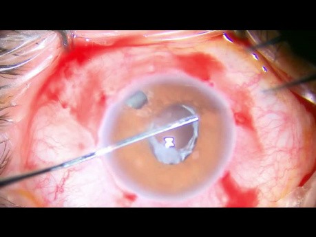 Wtórna implantacja soczewki z dodatkowym mocowaniem siatkówki