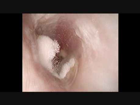 Otomykoza ucha lewego