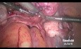 Tymczasowe podwiązanie tętnicy macicznej z zastosowaniem "węzła sznurowadłowego” przed miomektomią laparoskopową