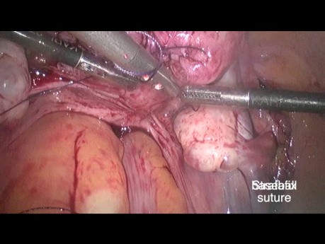 Tymczasowe podwiązanie tętnicy macicznej z zastosowaniem "węzła sznurowadłowego” przed miomektomią laparoskopową