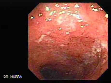 Badanie endoskopowe wrzodziejącego zapalenia jelita grubego (1 z 3)