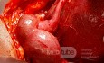 Wodniak jajowodu w przebiegu endometriozy