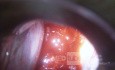Rak gruczołowy szyjki macicy (carcinoma glandulare colli uteri)