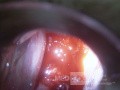 Rak gruczołowy szyjki macicy (Carcinoma Glandulare Colli Uteri)