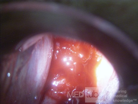 Rak gruczołowy szyjki macicy (carcinoma glandulare colli uteri)