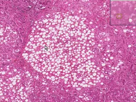 Alkoholowa choroba wątroby - histopatologia - liver