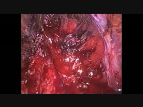 Zespolenie pęcherza z cewką moczową - laparoskopowa radykalna prostatektomia 