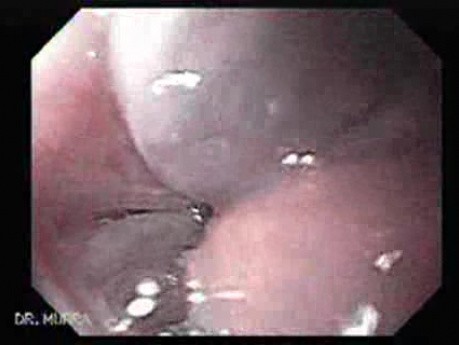Marskość wątroby - obraz blizn po eradykacji żylaków przełyku, część 2