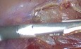 Laparoskopowa resekcja krętniczo-kątnicza w chorobie Leśniowskiego-Crohna