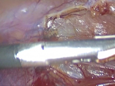 Laparoskopowa resekcja krętniczo-kątnicza w chorobie Leśniowskiego-Crohna