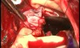 Wymiana pnia aorty z powodu zapalenia wsierdzia