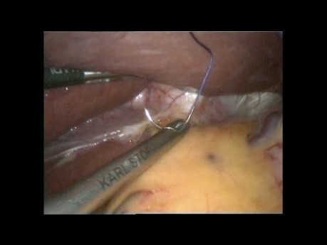 Całkowita resekcja żołądka D2 z resekcją węzłów chłonnych metodą laparoskopową