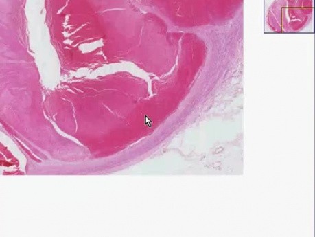 Zakrzepica żylna - żyła podkolanowa - histopatologia