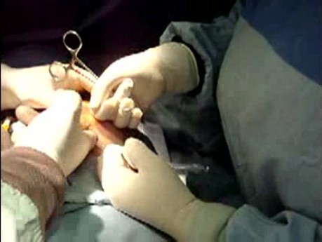 Operacja powiększenia piersi