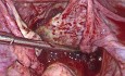 Ciąża jajnikowa- ciąża ektopowa zlokalizowana w jajniku