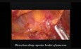 Laparoskopowa subtotalna resekcja trzustki z powodu nowotworu śluzowego torbielowatego
