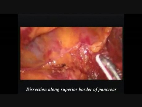 Laparoskopowa subtotalna resekcja trzustki z powodu nowotworu śluzowego torbielowatego